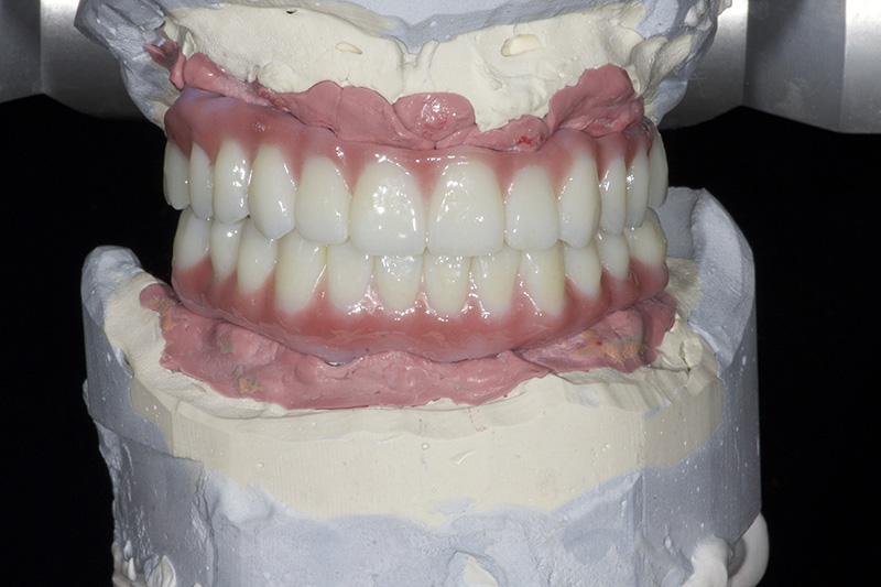 dental biomaterial ceramic porcelain