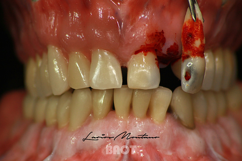 metal Ceramic Powder for Dental Lab