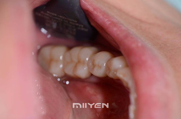 UT Multilayer dental zirconia block