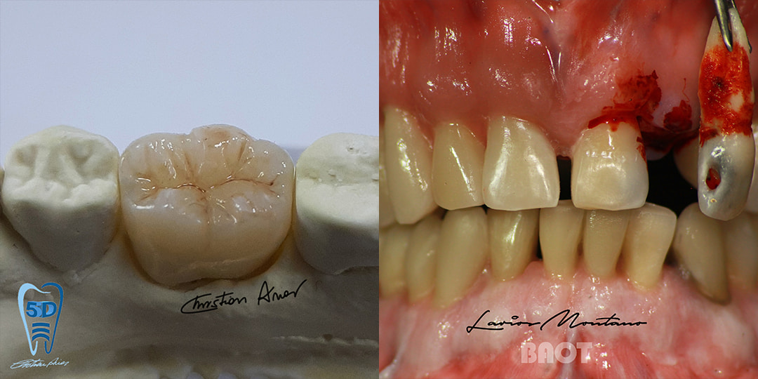 Dental porcelain bridge dentin transparent