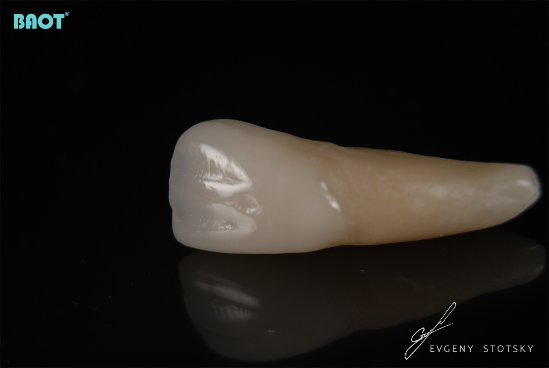 dental ceramic restoration