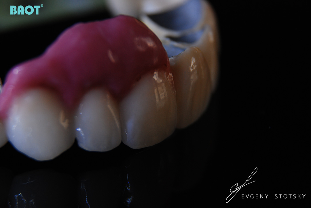 dental ceramics chroma and opacity