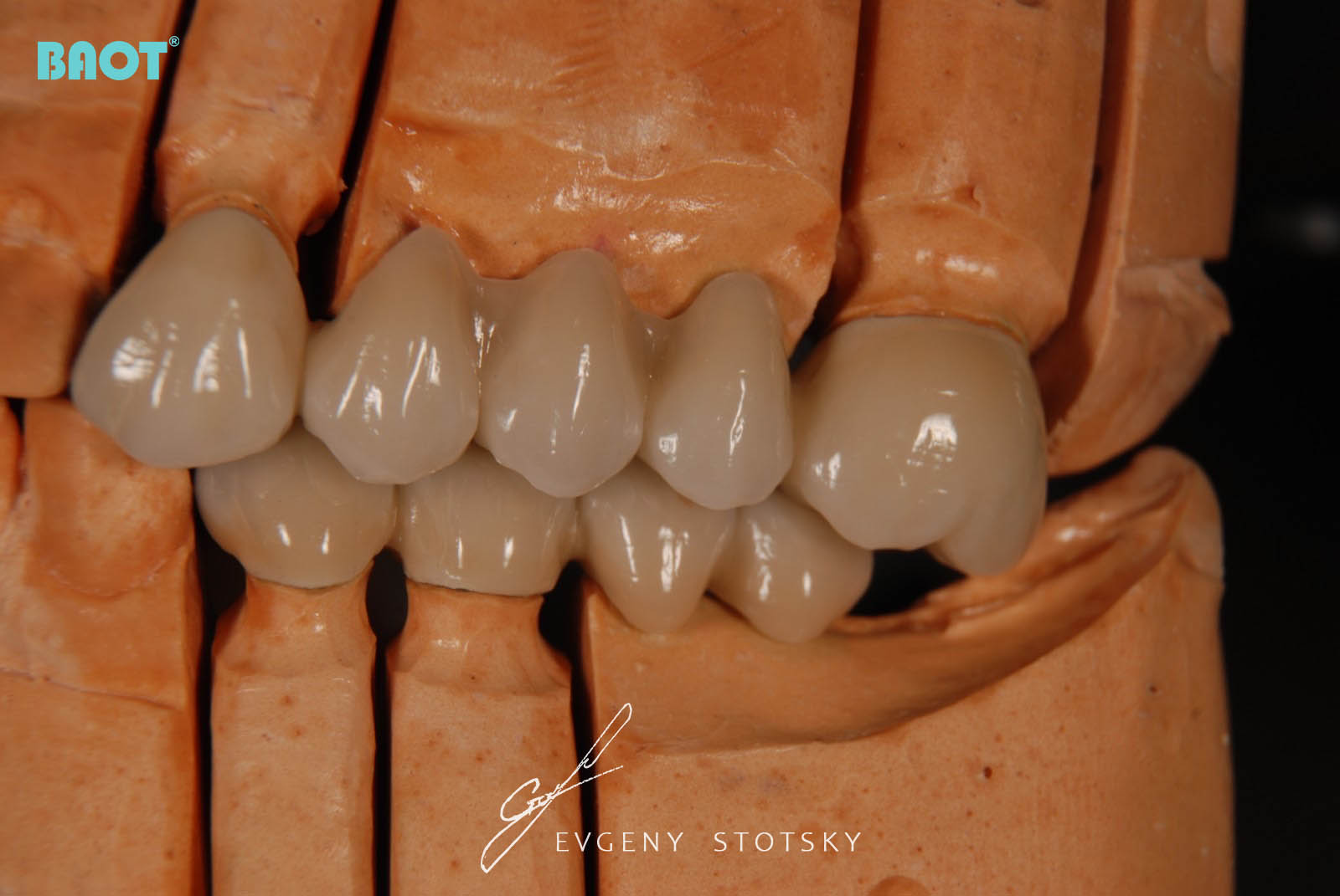 Ceramic Use for Dental Prosthesis