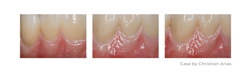 BAOT Aurora Dental Stain Glaze Case for Zirconia BAOT Aurora Dental Stain Glaze Case for Zirconia