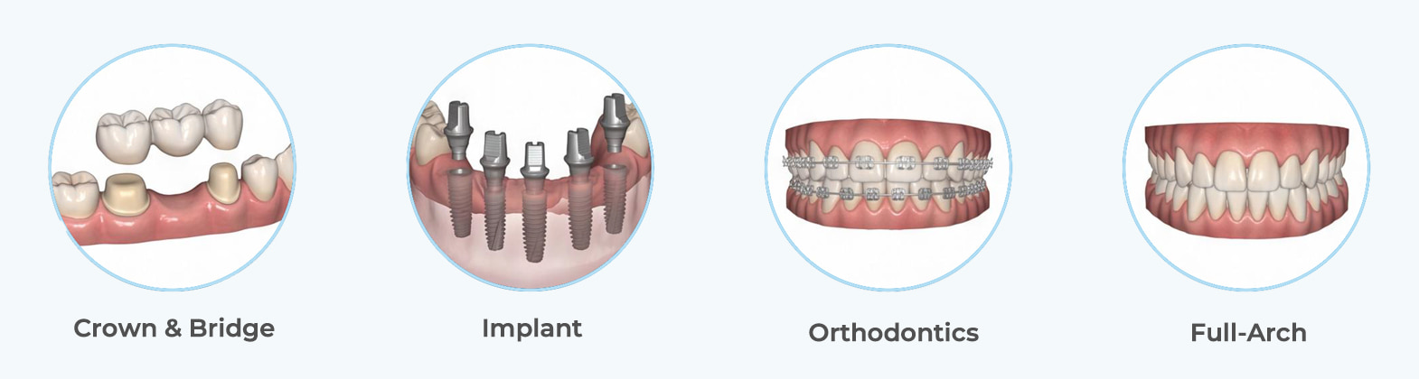 BAOT MS02 intraoral scanner for crown and bridge, implant, orthodontic, and full-arch applications BAOT MS02 intraoral scanner for crown and bridge, implant, orthodontic, and full-arch applications