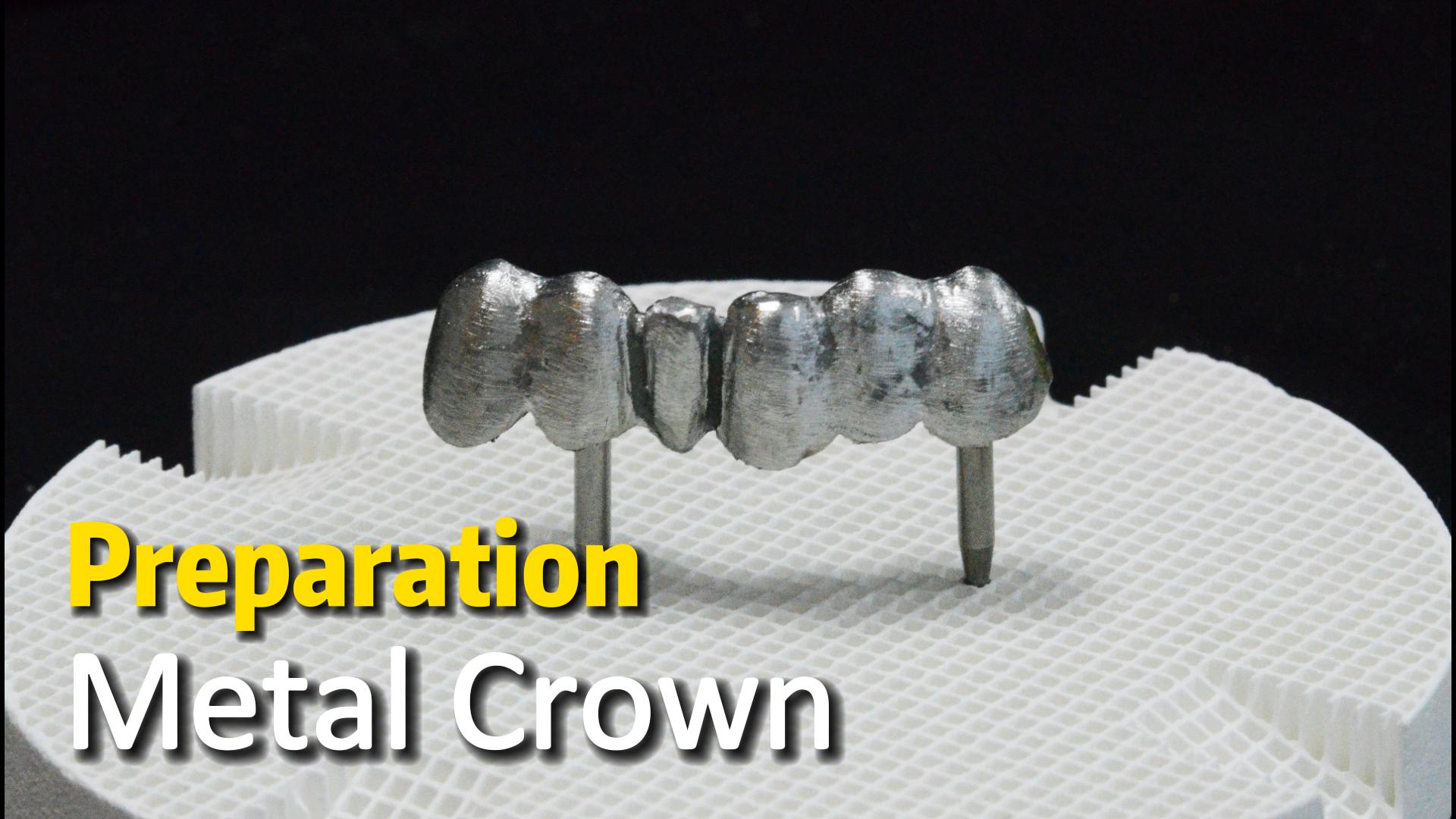 BAOT Ceramic | Metal Crown Preparation
